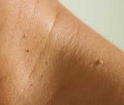 Skin Tag Removal